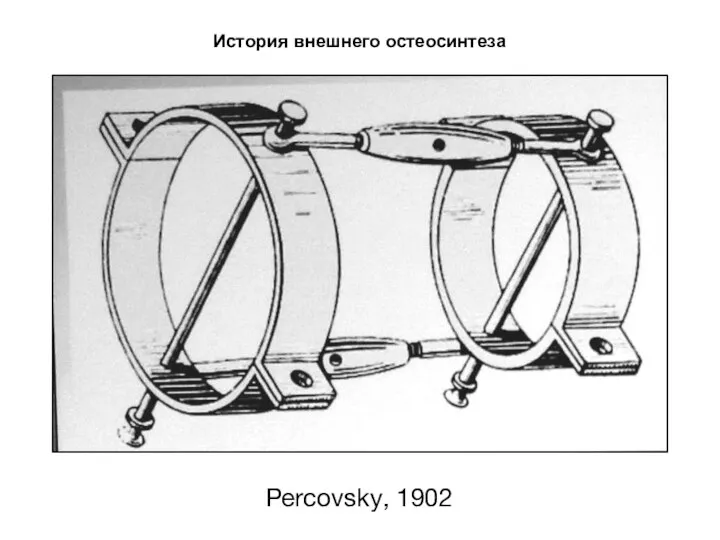 Percovsky, 1902 История внешнего остеосинтеза