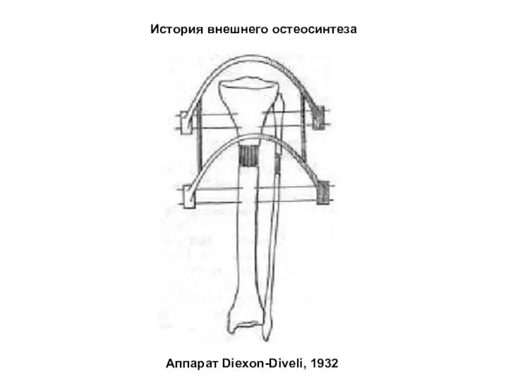 Аппарат Diexon-Diveli, 1932 История внешнего остеосинтеза