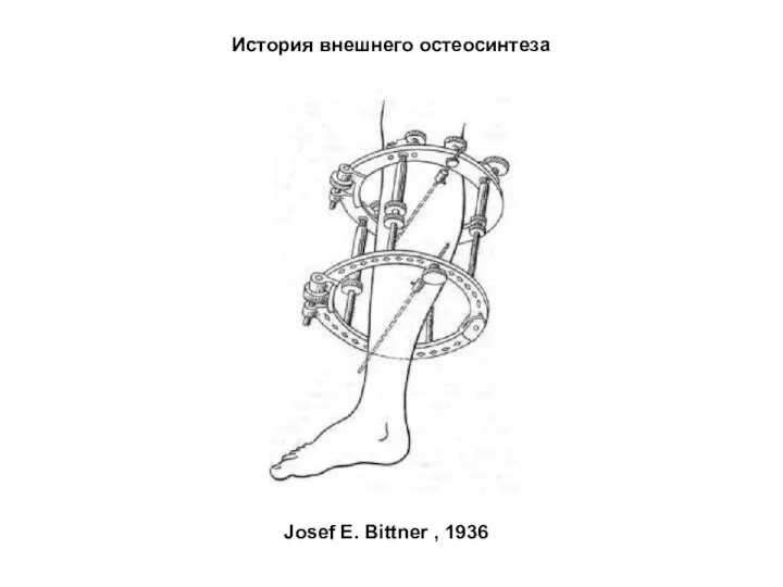 История внешнего остеосинтеза Josef E. Bittner , 1936
