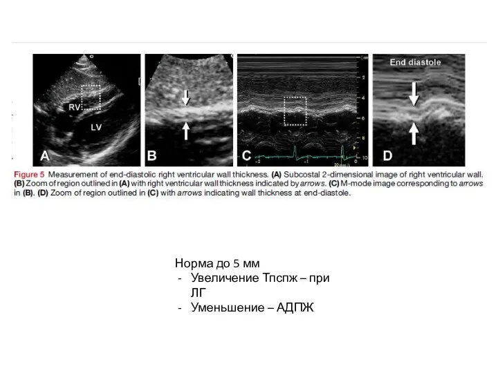 Норма до 5 мм Увеличение Тпспж – при ЛГ Уменьшение – АДПЖ