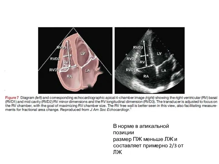 В норме в апикальной позиции размер ПЖ меньше ЛЖ и составляет примерно 2/3 от ЛЖ