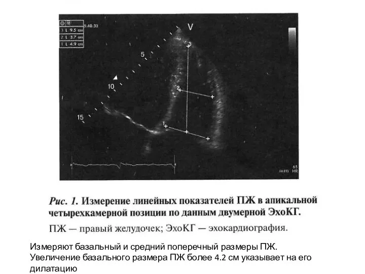 Измеряют базальный и средний поперечный размеры ПЖ. Увеличение базального размера ПЖ