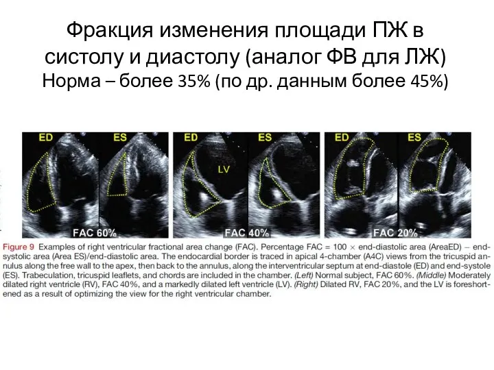 Фракция изменения площади ПЖ в систолу и диастолу (аналог ФВ для