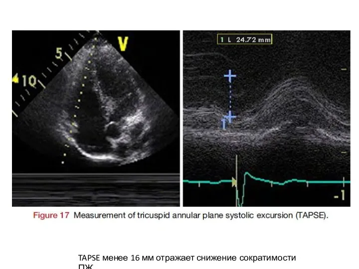 TAPSE менее 16 мм отражает снижение сократимости ПЖ