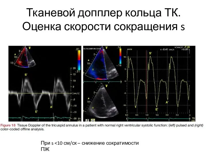 Тканевой допплер кольца ТК. Оценка скорости сокращения s При s