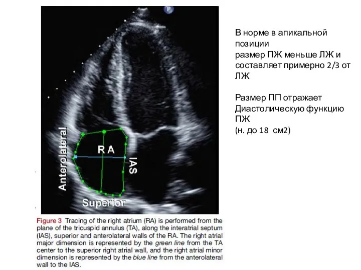 В норме в апикальной позиции размер ПЖ меньше ЛЖ и составляет
