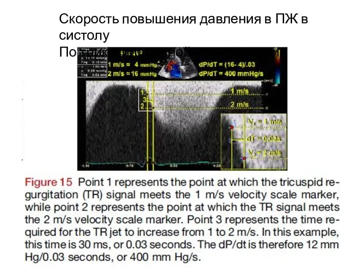 Скорость повышения давления в ПЖ в систолу По трикуспидальной регургитации