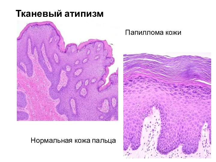 Тканевый атипизм Папиллома кожи Нормальная кожа пальца