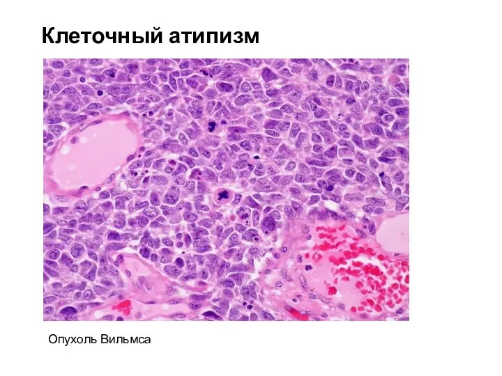 Клеточный атипизм Опухоль Вильмса