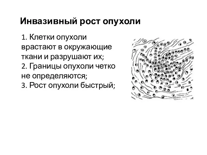 Инвазивный рост опухоли 1. Клетки опухоли врастают в окружающие ткани и