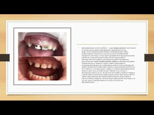 формирования зачатка зубов, т. е. до прорезывания:гипоплазия и гиперплазия эмали (врождённое