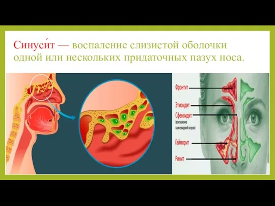 Синуси́т — воспаление слизистой оболочки одной или нескольких придаточных пазух носа.