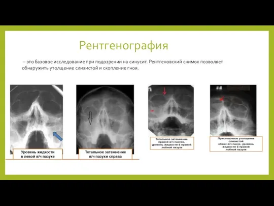 Рентгенография – это базовое исследование при подозрении на синусит. Рентгеновский снимок