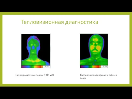 Тепловизионная диагностика Нос и придаточные пазухи (НОРМА) Воспаление гайморовых и лобных пазух