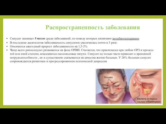 Синусит занимает 5 место среди заболеваний, по поводу которых назначают антибиотиктерапию.