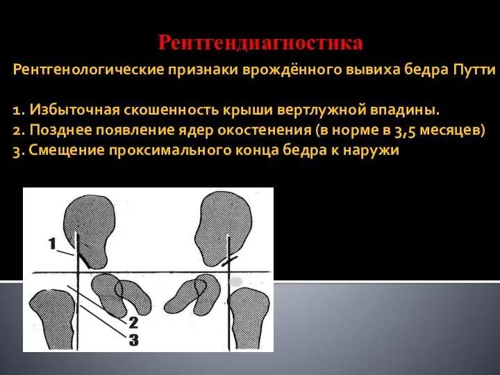 Рентгенологические признаки врождённого вывиха бедра Путти 1. Избыточная скошенность крыши вертлужной