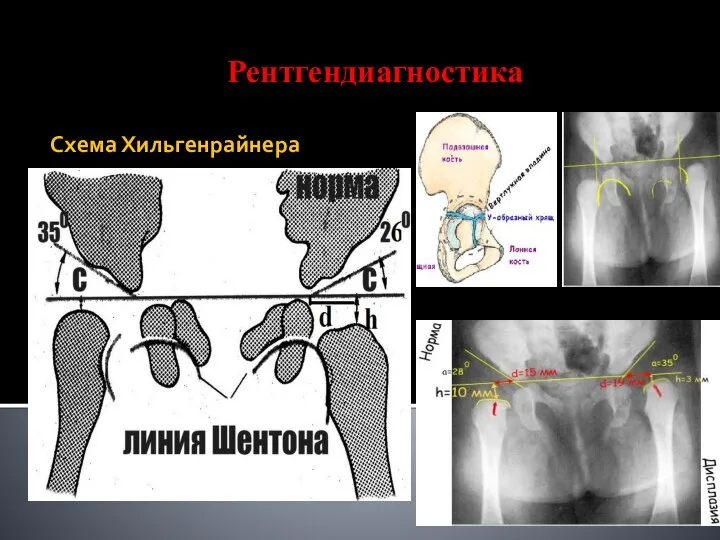 Схема Хильгенрайнера Рентгендиагностика