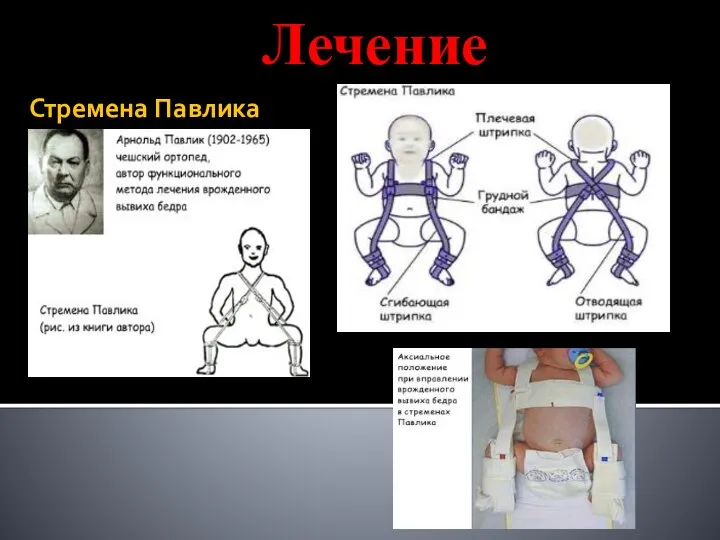 Стремена Павлика Лечение