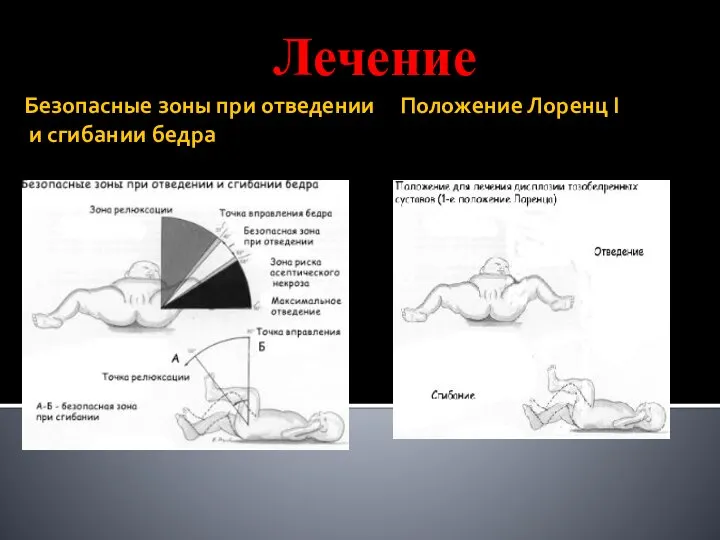 Безопасные зоны при отведении Положение Лоренц I и сгибании бедра Лечение