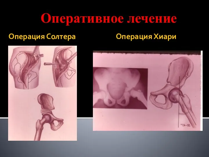 Операция Солтера Операция Хиари Оперативное лечение