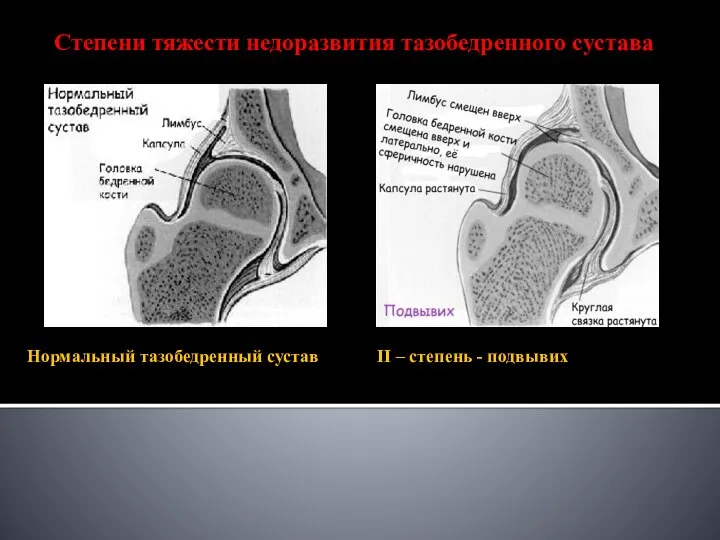 Нормальный тазобедренный сустав II – степень - подвывих Степени тяжести недоразвития тазобедренного сустава