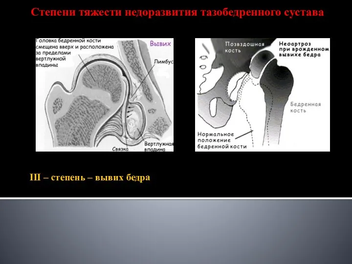 III – степень – вывих бедра Степени тяжести недоразвития тазобедренного сустава