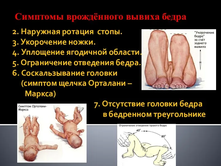 2. Наружная ротация стопы. 3. Укорочение ножки. 4. Уплощение ягодичной области.