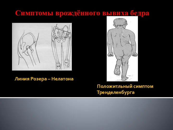 Линия Розера – Нелатона Положитльный симптом Тренделенбурга Симптомы врождённого вывиха бедра