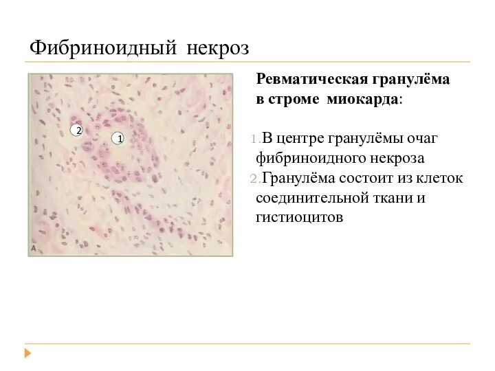 Фибриноидный некроз Ревматическая гранулёма в строме миокарда: В центре гранулёмы очаг