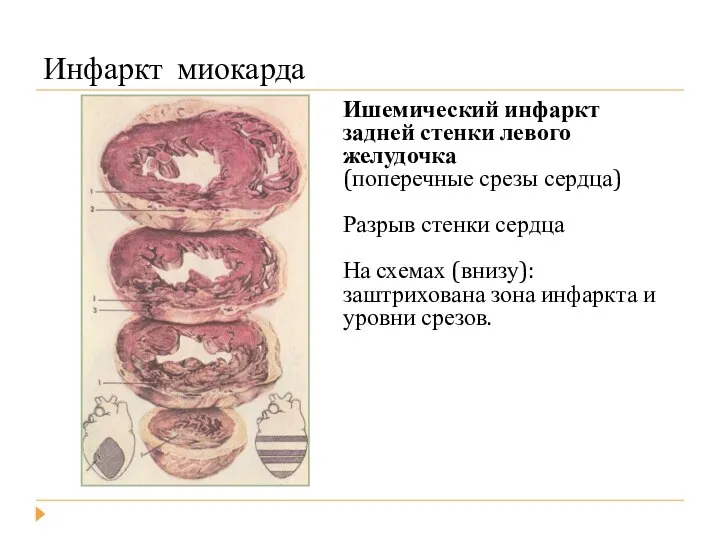 Инфаркт миокарда Ишемический инфаркт задней стенки левого желудочка (поперечные срезы сердца)