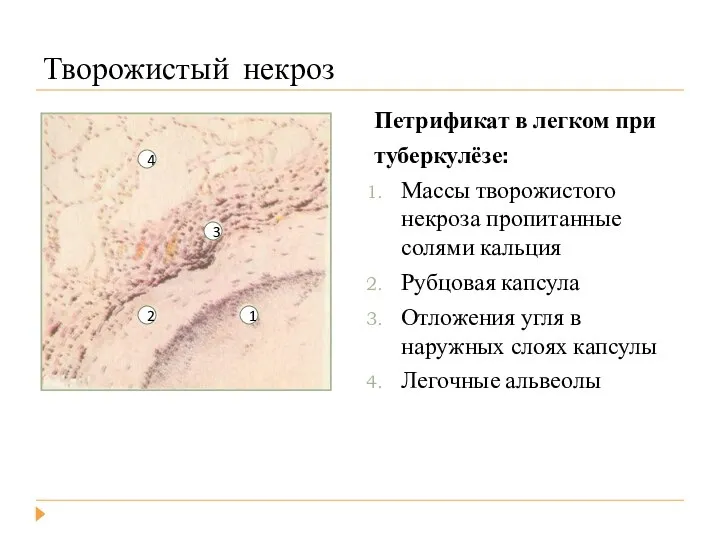 Творожистый некроз Петрификат в легком при туберкулёзе: Массы творожистого некроза пропитанные