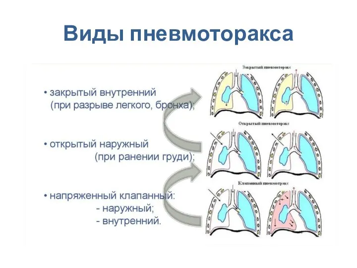 Виды пневмоторакса