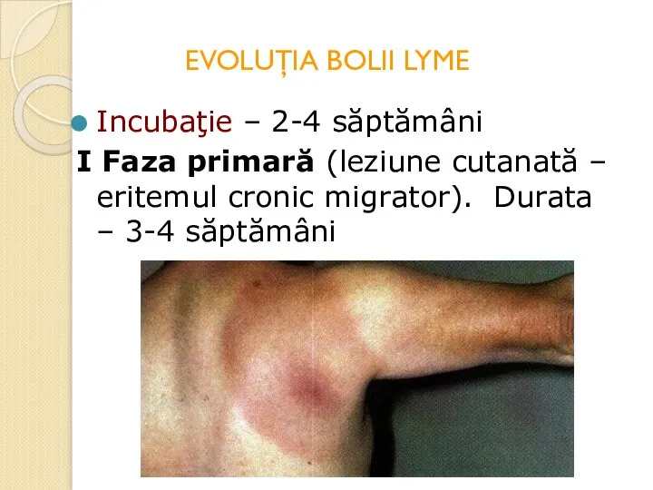 EVOLUŢIA BOLII LYME Incubaţie – 2-4 săptămâni I Faza primară (leziune