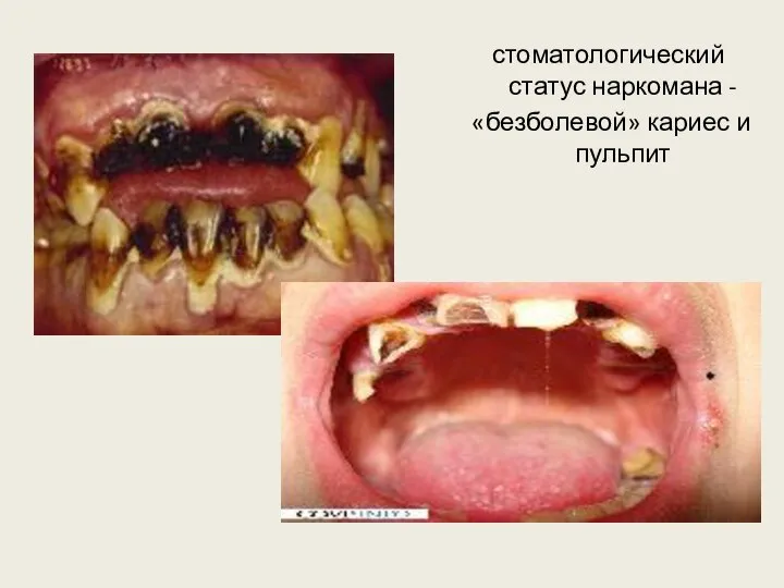 стоматологический статус наркомана - «безболевой» кариес и пульпит