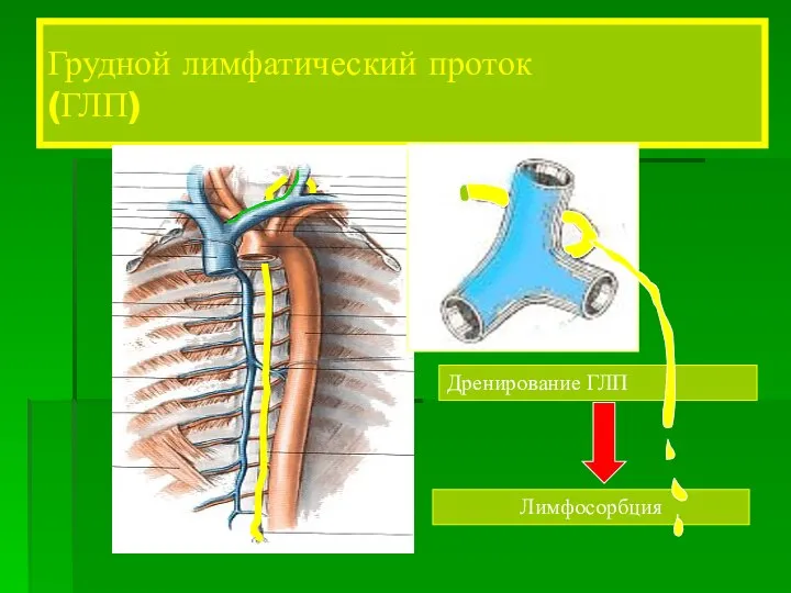 Грудной лимфатический проток (ГЛП) Лимфосорбция Дренирование ГЛП