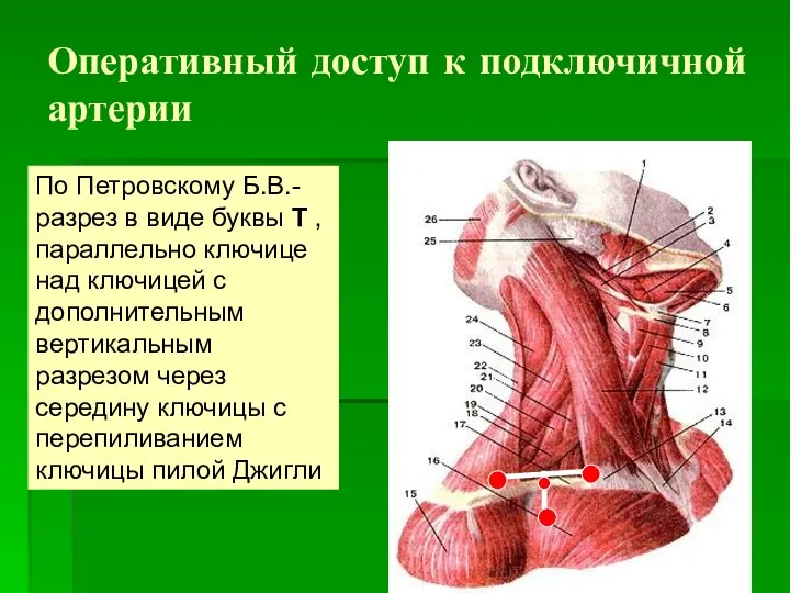 Оперативный доступ к подключичной артерии По Петровскому Б.В.-разрез в виде буквы