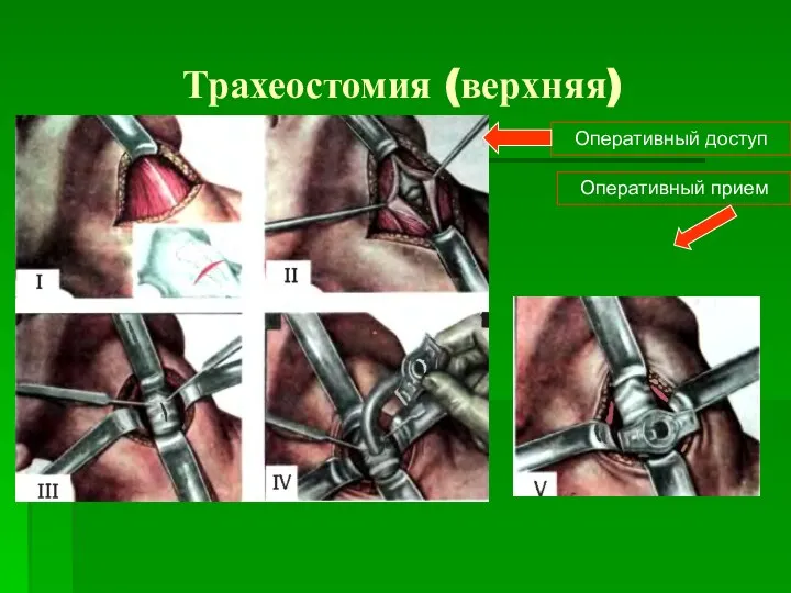 Трахеостомия (верхняя) Оперативный доступ Оперативный прием