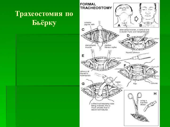 Трахеостомия по Бьёрку