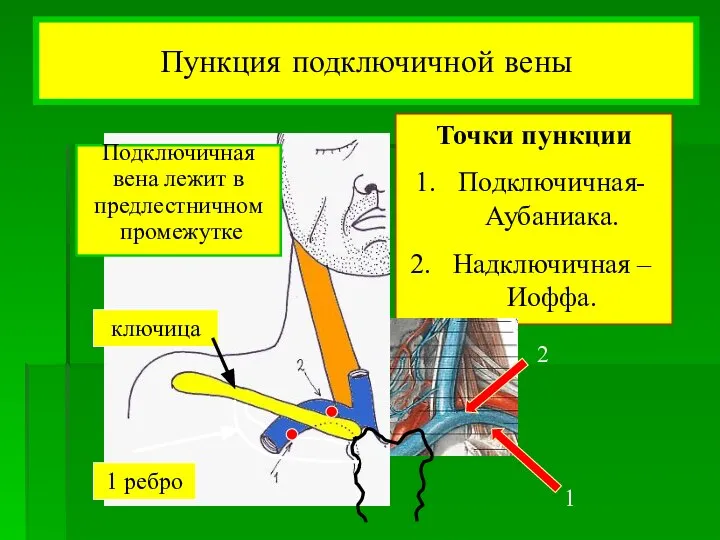 Пункция подключичной вены Точки пункции Подключичная- Аубаниака. Надключичная –Иоффа. 2 1