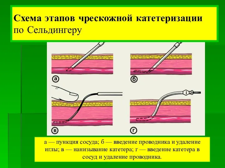 а — пункция сосуда; б — введение проводника и удаление иглы;