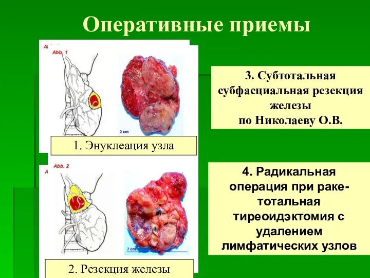 Оперативные приемы 1. Энуклеация узла 2. Резекция железы 3. Субтотальная субфасциальная