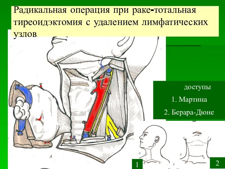 Радикальная операция при раке-тотальная тиреоидэктомия с удалением лимфатических узлов доступы 1. Мартина 2. Берара-Дюне 1 2