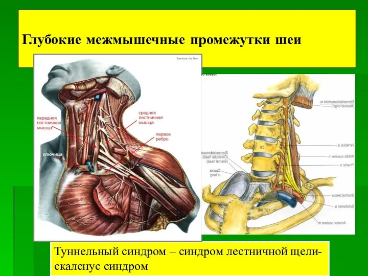 Глубокие межмышечные промежутки шеи Туннельный синдром – синдром лестничной щели-скаленус синдром