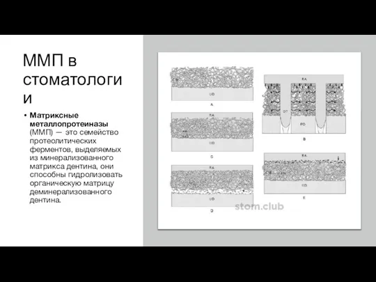 ММП в стоматологии Матриксные металлопротеиназы (ММП) — это семейство протеолитических ферментов,