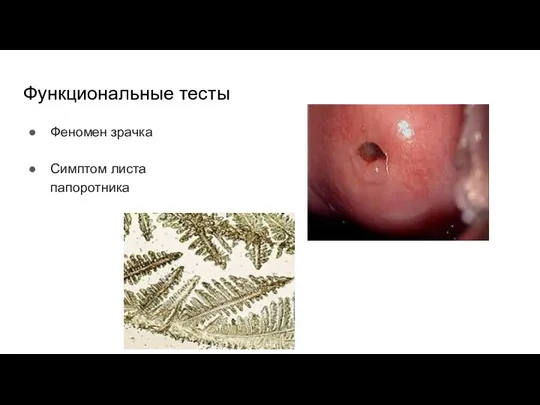 Функциональные тесты Феномен зрачка Симптом листа папоротника