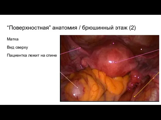 “Поверхностная” анатомия / брюшинный этаж (2) Матка Вид сверху Пациентка лежит на спине