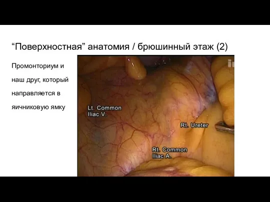 “Поверхностная” анатомия / брюшинный этаж (2) Промонториум и наш друг, который направляется в яичниковую ямку