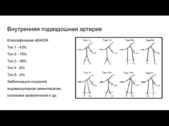 Внутренняя подвздошная артерия Классификация ADACHI Тип 1 - 42% Тип 2