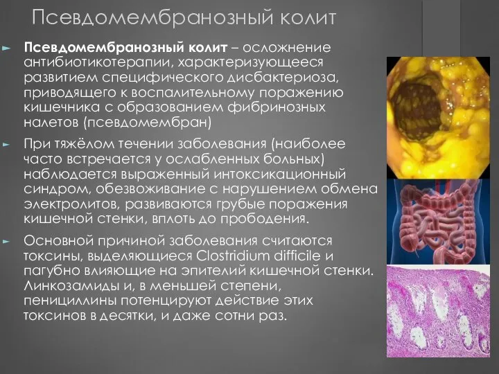 Псевдомембранозный колит Псевдомембранозный колит – осложнение антибиотикотерапии, характеризующееся развитием специфического дисбактериоза,