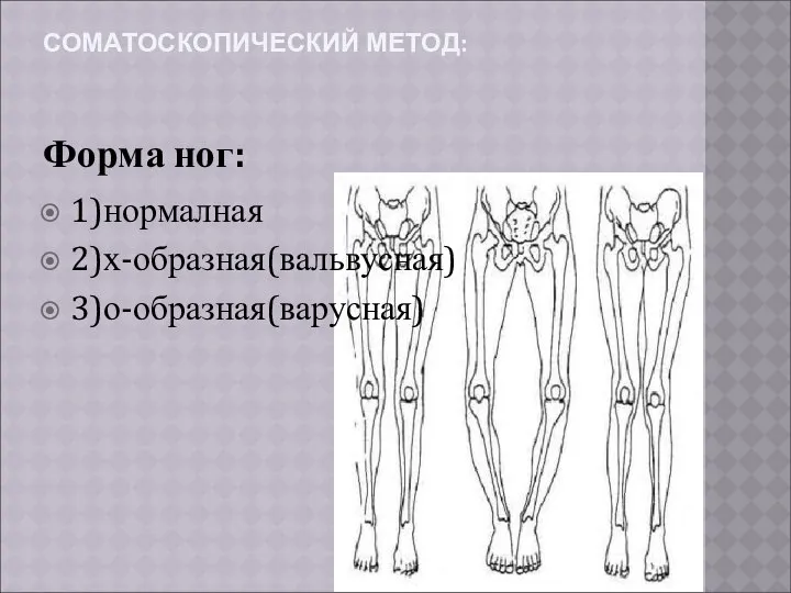 СОМАТОСКОПИЧЕСКИЙ МЕТОД: Форма ног: 1)нормалная 2)х-образная(вальвусная) 3)о-образная(варусная)